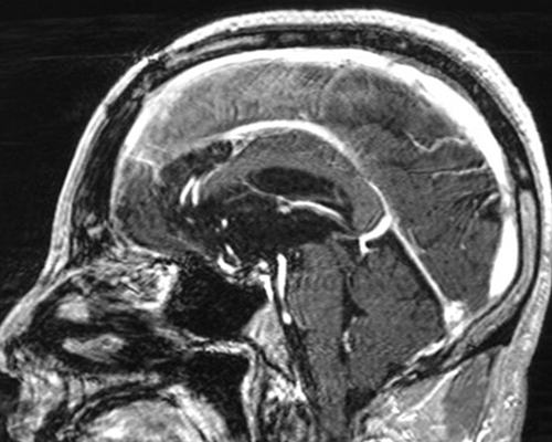 聴神経腫瘍　外側後頭下開頭手術 術後