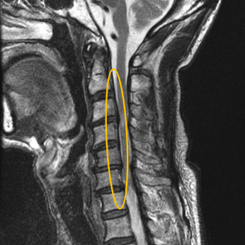 頚椎症の手術方法