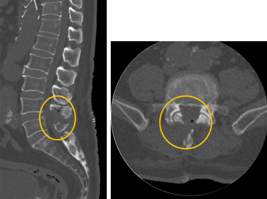 腰部脊柱管狭窄症・腰椎椎間板ヘルニアの手術方法