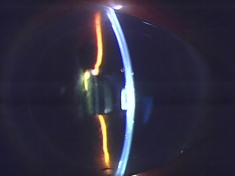 角膜内皮移植後10か月，視力は(1.0)