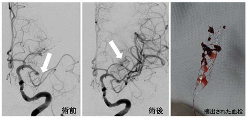 中大脳動脈閉塞症に対する緊急血栓回収療法