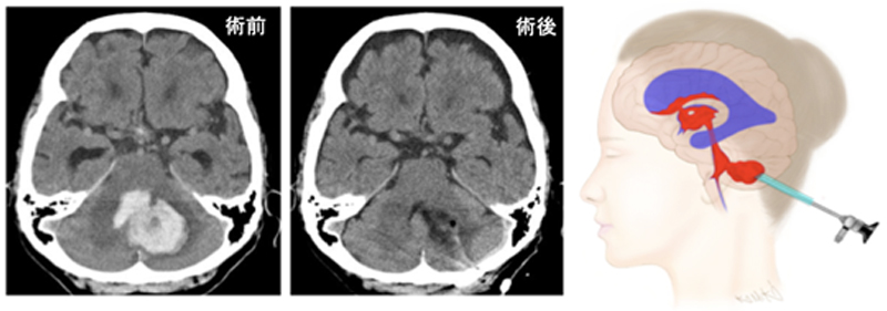 脳出血に対する内視鏡下血腫除去術