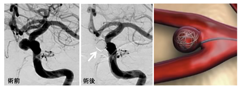 脳動脈瘤コイル塞栓術