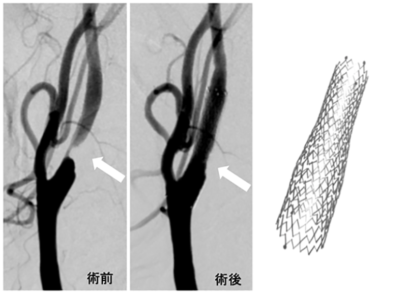頸動脈ステント留置術