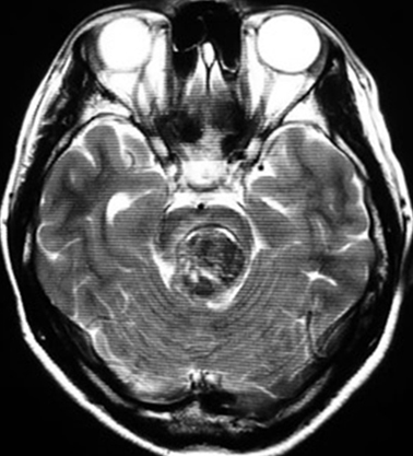 聴神経腫瘍　外側後頭下開頭手術 術前