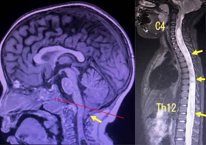 脊髄空洞症を伴うキアリ１型奇形