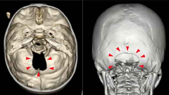 大後頭孔部減圧術 (foramen magnum decompression: FMD) 後の状態