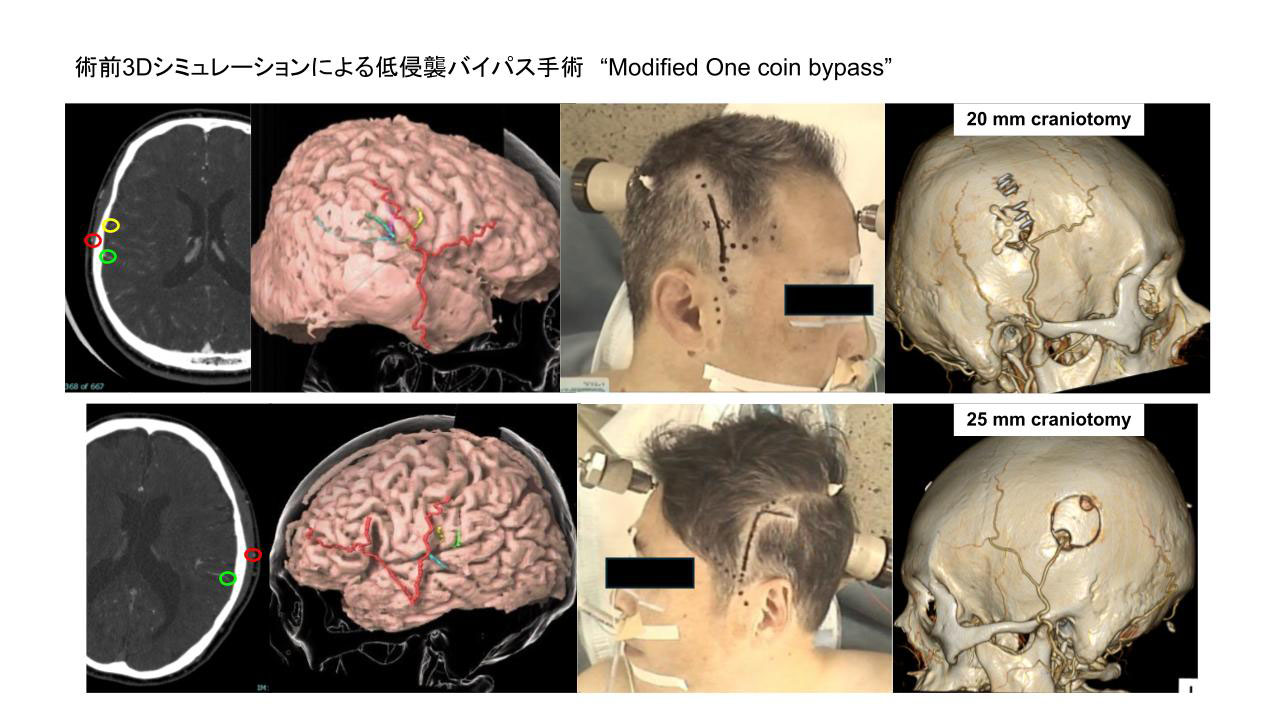 もやもや病 専門外来