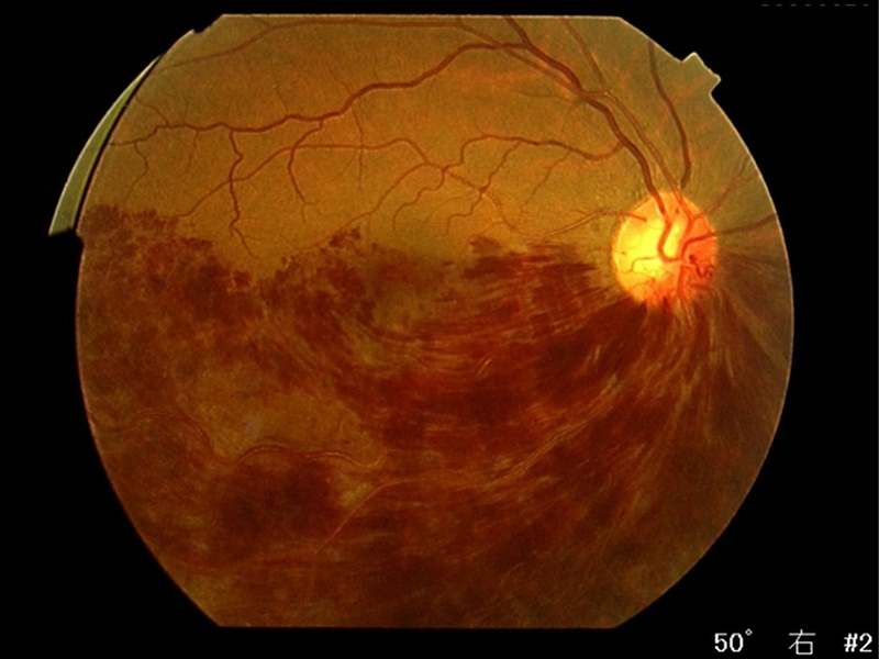 網膜分枝静脈閉塞症