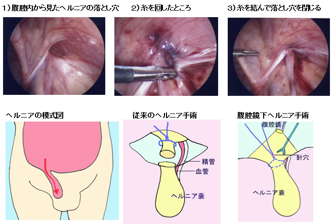 小児外科 そけいヘルニア 福岡大学医学部呼吸器外科