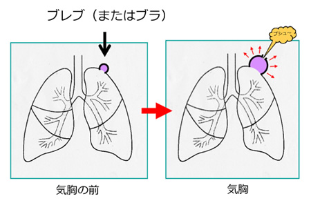 気胸 福岡大学医学部呼吸器外科