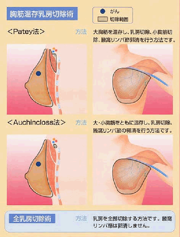 よくあるご質問 乳がん 福岡大学医学部呼吸器外科