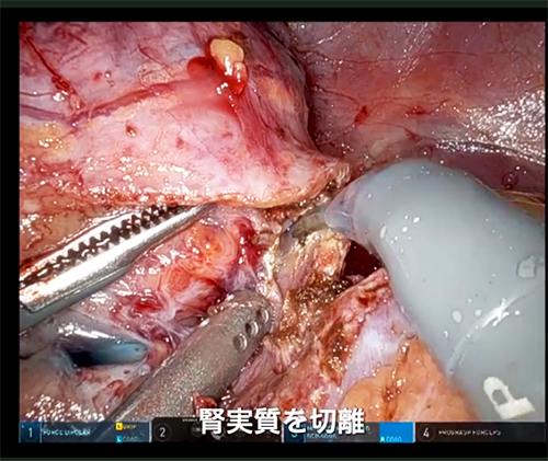 羽賀教授の手術動画がエチコン ESS website (医療従事者専用動画サイト)に掲載されました