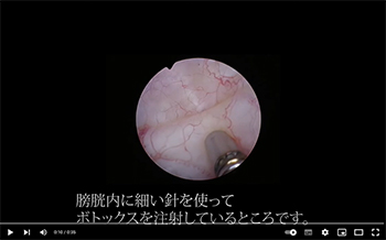 難治性過活動膀胱に対するボトックス治療 福岡大学医学部腎泌尿器外科学講座